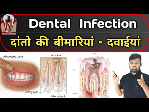 दांतो का संक्रमण | Dental Infection | Medicine | Medicine knowledge | Doctor | Dentist | Nursing