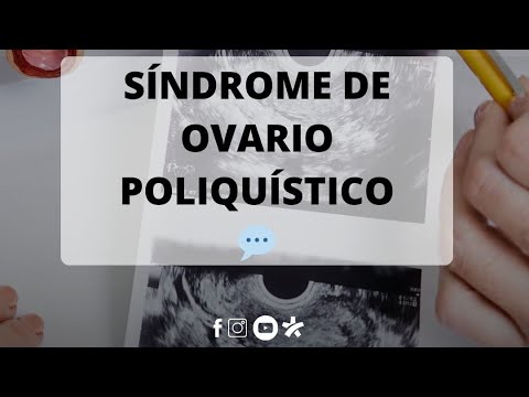 Síndrome de Ovario Poliquístico una de las condiciones más comunes en mujeres en edad reproductiva.