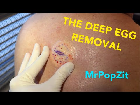 The deep egg in the back removal. Perfect sphere removed. 2 week follow up at end of video.