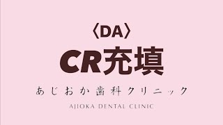 【歯科助手】CR充填