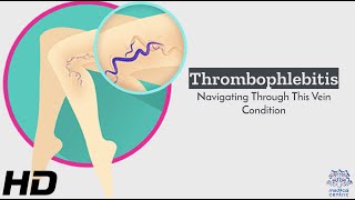 Thrombophlebitis 101: Navigating the Challenges of Vein Conditions