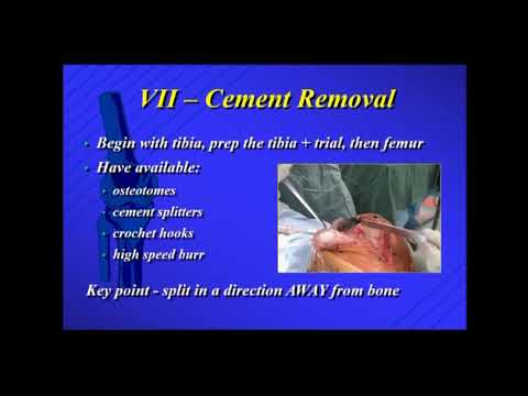 Presenter spoke about component, cement removal in revision TKA