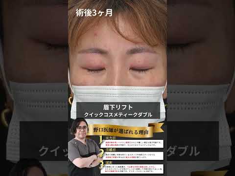 瞼のたるみを取って若々しく！#湘南美容クリニック京橋院 ＃眉下リフト＃埋没