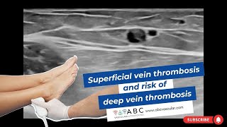 Superficial vein thrombosis and risk of deep vein thrombosis