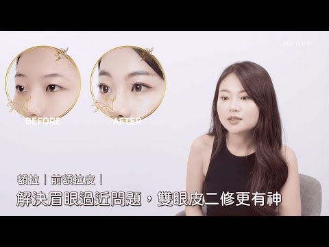 額拉｜前額拉皮｜解決眉眼過近問題，雙眼皮二修更有神。 #醫美診所 #耐斯診所 #醫美 #醫美品牌 #案例 #案例分享  #心得 #心得分享 #素人 #分享 #前額拉皮 #拉皮 #拉皮手術 #雙眼皮