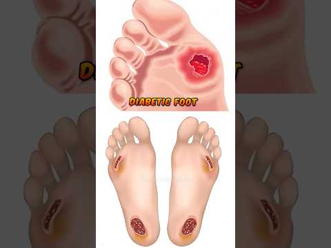 Diabetic Foot | சர்க்கரை நோயினால் ஏற்படும் புண்