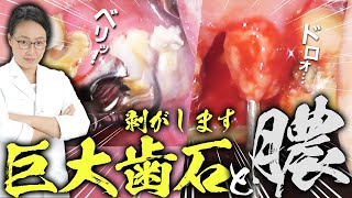 一気に治療‼️1回で歯が復活🦷大量歯石、膿袋除去、抜歯など～Tooth restored in one session🦷Massive tartar, pus bag removal, tooth