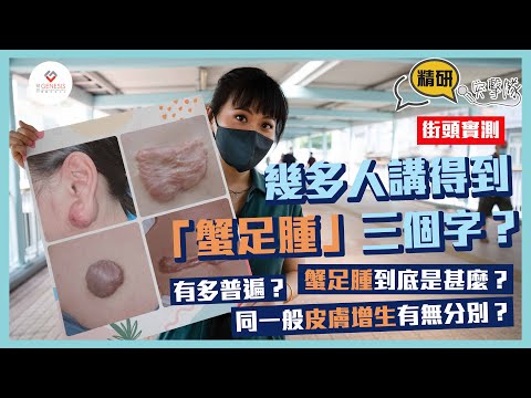 【精研突擊隊】EP1 街頭實測｜幾多人講得到「蟹足腫」三個字？｜蟹足腫到底是甚麼？有多普遍？同一般皮膚增生有無分別？