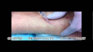 靜脈曲張表皮硬化劑注射治療 , Sclerotherapy for leg spider veins -  陳建彰診所 / 宇成診所 - 靜脈曲張專科診所