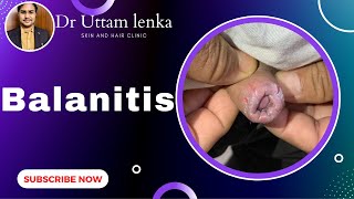 Balanitis / crack of fore skin of penis/ candidiasis/ medicines for penis infection/Dr Uttam Lenka