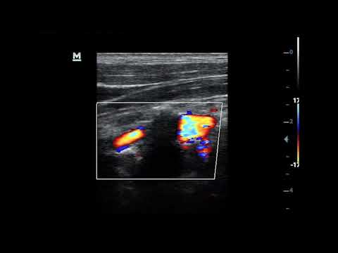 Vertebro vertebral arteriovenous fistula (VV-AVF) after penetrating trauma. Duplex Images and Videos