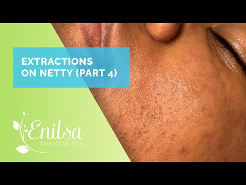 Deep Blackheads Extractions on Netty - Fourth Treatment