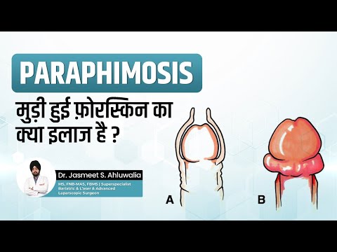 What is Paraphimosis in Hindi - its Symptoms & Treatment | Foreskin peechay atak jaye to kya karein?