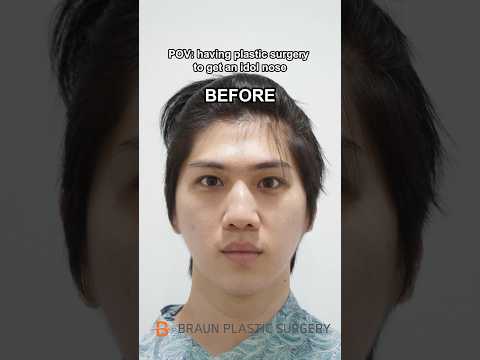 I got an IDOL nose in Korea😍 #fyp #glowup #rhinoplasty #beforeandafter #viralvideo #explore #idol