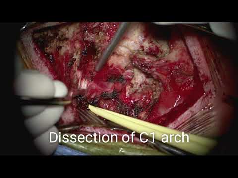 Vertebral artery mobilization for C1–2 reduction and fixation