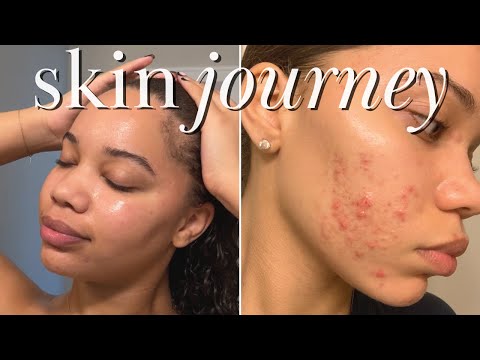 how I cleared my skin | trying curology | Kaila Kake