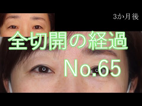 全切開二重手術65　50代女性：取れかかった埋没法の固定と目尻側のたるみ切除。そんなに見た目を変えない場合