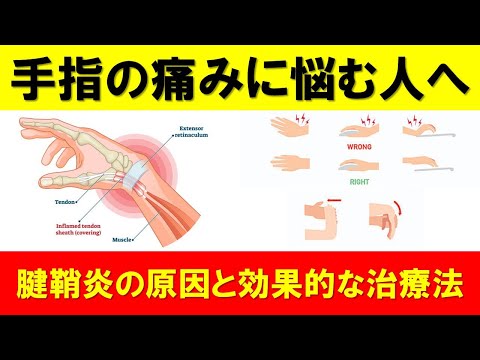 手指の痛みに悩む人必見！腱鞘炎の原因と効果的な治療法、日常生活で気をつけるところ