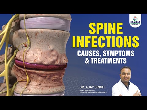 Top Causes of Spine Infections and How to Treat Them | Dr Ajay Spine Specialist at Healing Hospital