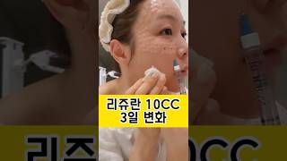 #리쥬란힐러 10cc 셀프시술 후 엠보변화😊