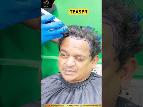 #Trailer #actor #marathi #ankurwadhve #hairtransplant #journey #shorts #ytshorts