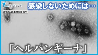 【ヘルパンギーナ】が猛威　鳥取では警報も　感染しないためには？　鳥取県・島根県