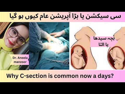 Bacha Ulta ya seedha? C section Q Common ho Gaya ha? बेबी सीधा या उल्टा पेट मैं breech or cephalic