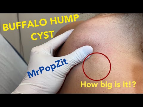 The buffalo hump cyst.Large cyst tucked right up against a pocket of fat cells on posterior neck