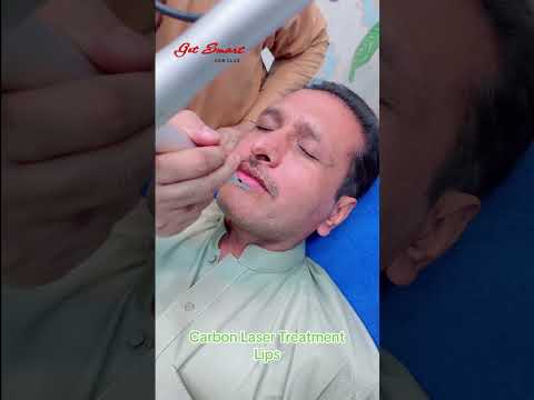 Carbon peel Treatment #getsmarthairclub #hairremoval #viralvideo