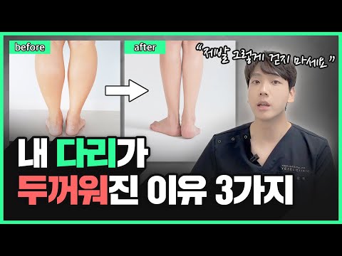 "원래 내 다리는 훨씬 날씬하다!" 내 다리가 두꺼워진 진짜 이유 3가지 | 종아리 예뻐지는 습관, 걷는 방법, 종아리 보톡스