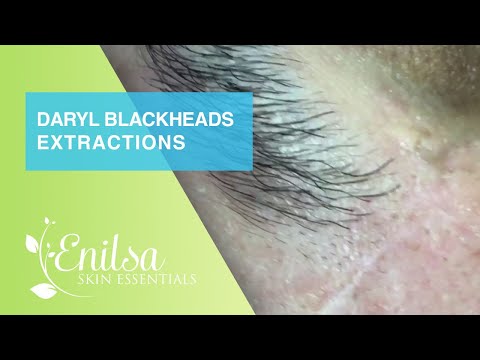 Extractions of Blackheads and Cyst on Daryl