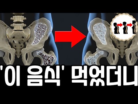 숭숭 구멍이 난 뼈! '이 음식들' 먹었더니 구멍이 채워져서 놀랐다. 골다공증에좋은음식