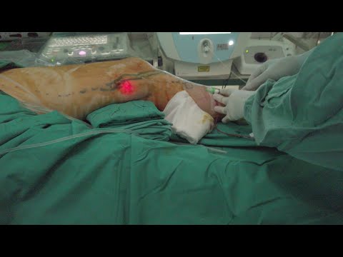 Laser ablation of the Great Saphenous Vein