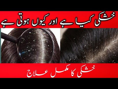 Dandruff Kya  ha || Dandruff removal ||Dandruff treatment at home ||