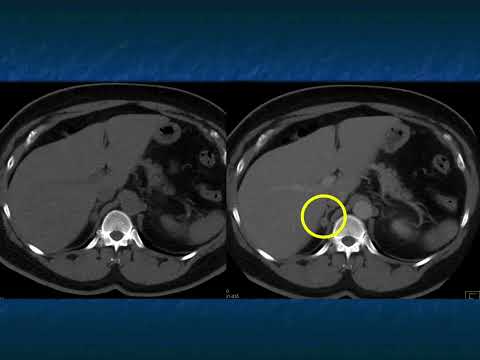 CT of the Large (greater than 4cm) Adrenal Mass: Pearls and Pitfalls - Part 1