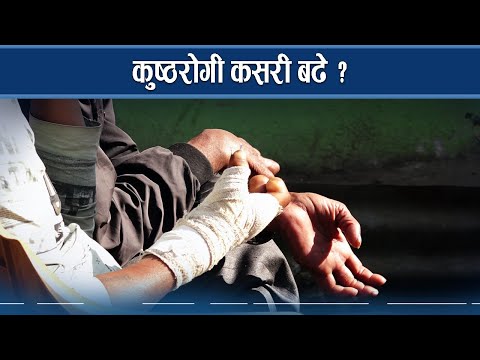 निवारणको घोषणा मात्रै, कुष्ठरोगीको संख्या झनझन बढ्दै  - NEWS24 TV