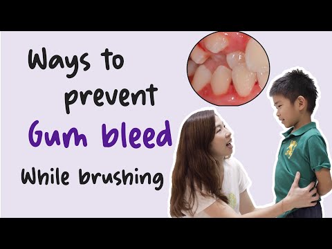 EP 85: Ways to prevent gum bleeding while brushing