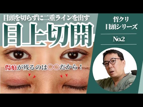 【目の上切開】切開なしで理想の二重ラインに？傷痕の心配なし？目上切開ってなに？哲クリ目頭シリーズNo.3