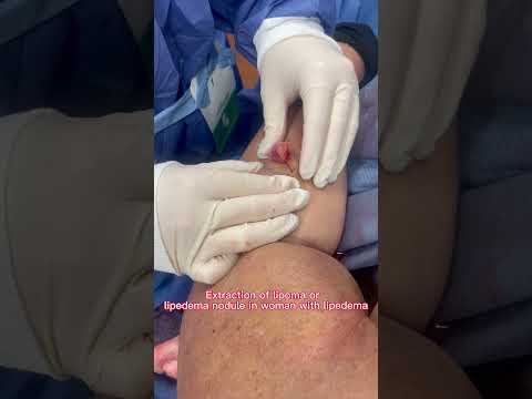 Extraction of lipoma or  lipedema nodule in woman with lipedema