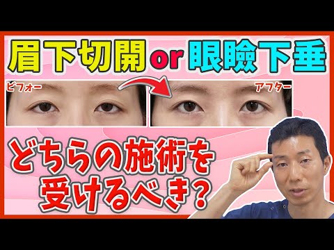 【目の開き】眉下切開と眼瞼下垂のどちらを受けるべき？【まぶた(瞼)の整形】