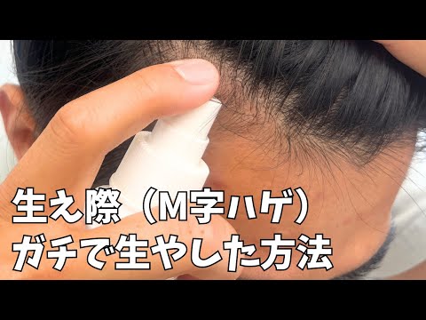 【永久保存版】M字ハゲ(生え際の薄毛) を本気で治した方法とは？【5年間】