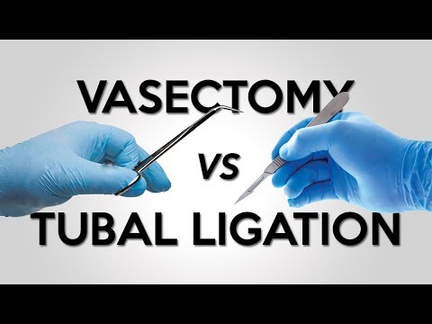 Vasectomy vs Tubal Ligation