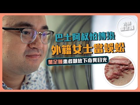 【告別蟹足腫】EP2 巴士阿叔怕傳染｜外籍女士當蜈蚣｜蟹足腫患者籲放下奇異目光