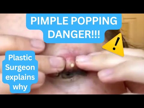 Pimple Popping Danger! Dr. A explains the risks