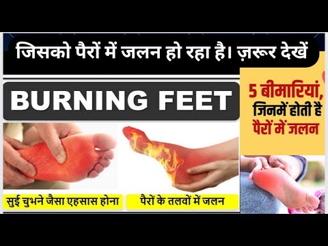 पैरों के तलवों में जलन का इलाज, पैरों में जलन होने से कौन सी बीमारी होती है?, Burning Feet Treatment