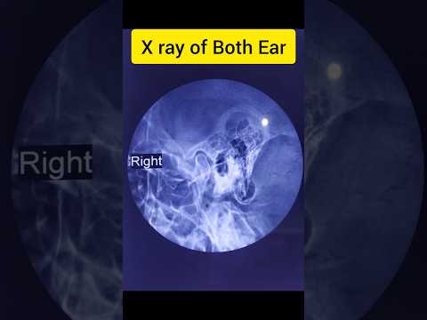 X-Ray Of Both Ear|Schuller Views|