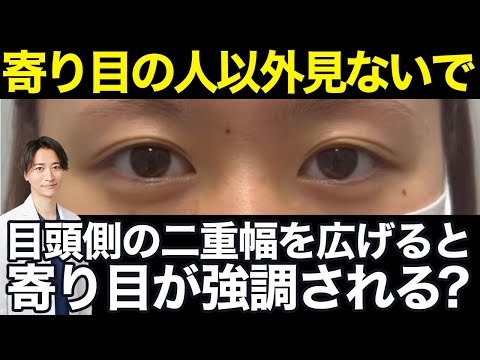 【二重埋没】目頭側の幅を広げるのは厳禁？寄り目の人の二重幅について医師が解説【二重整形/目 整形】