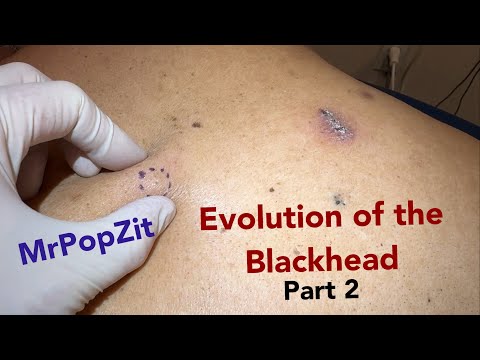 Evolution of the blackhead part 2. Great visual dissection of the pathway from pore to cyst.