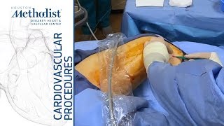 Endovenous Laser Treatment (EVLT) of the Greater Saphenous Vein (Ulises Baltazar, MD)