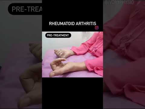 #rehab #rheumatoid #arthritis #pain #cure #exercise #mobility #physiotherapy